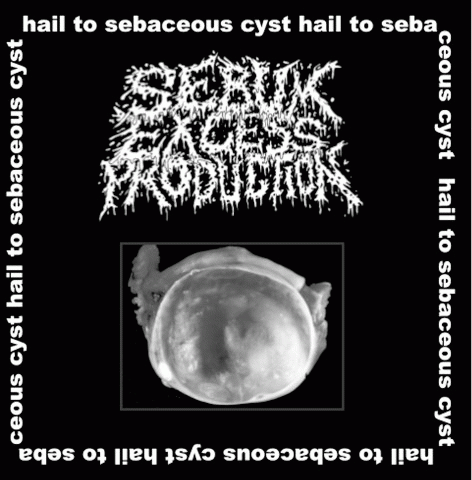 Sebum Excess Production : Hail to Sebaceous Cyst! Sebum Excess Production : Hail to Sebaceous Cyst!